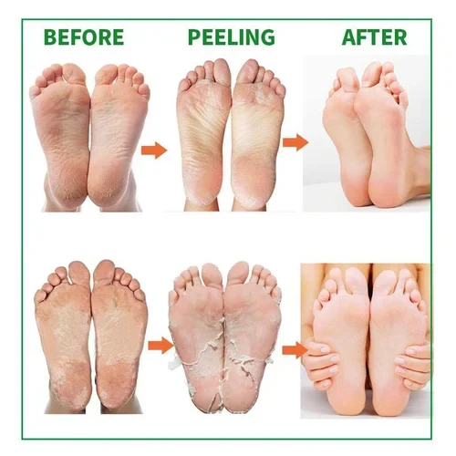 Ultimate 7-Day Deep Exfoliating Foot Mask